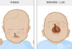 兔唇必須要修復(fù)嗎？怎么修復(fù)兔唇？