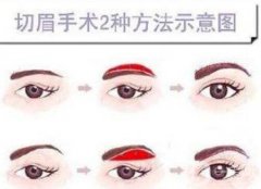 切眉術(shù)會產(chǎn)生疤痕嗎?