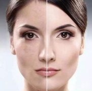 激光美膚有哪些類型?激光美膚手術(shù)后的注意事項有哪些?