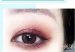 割雙眼皮可以修復嗎?雙眼皮切開后的注意事項