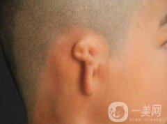 先天性小耳畸形的原因是什么?先天性小耳畸形應(yīng)該怎么調(diào)節(jié)?