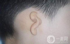 先天性小耳畸形需要調(diào)節(jié)嗎?