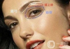 誰做過眉弓隆高?眉弓隆高術(shù)是什么?