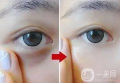 激光去除黑眼圈會(huì)不會(huì)反彈？果能維持多久？