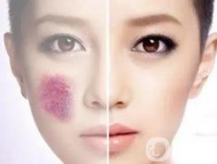 激光去除胎記有什么危害？原理是什么？