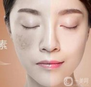 激光祛斑后吃什么可以恢復較快呢？