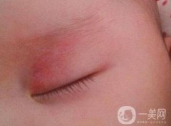 什么是鮮紅斑痣?如何用激光調節(jié)鮮紅斑痣?