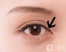 紋美瞳線會不會掉睫毛呢?紋瞳孔線掉睫毛應該怎么辦?