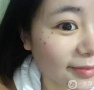嘴唇上的痣是什么意思呢?嘴唇上的痣能去掉嗎?