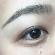 臥蠶可以去掉嗎？如何去掉？