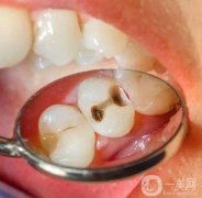 補(bǔ)牙洞需要打麻藥嗎？