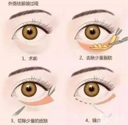 超聲波去眼袋有哪些危害？