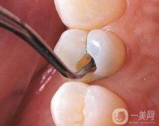 補(bǔ)牙洞需要做多少次？