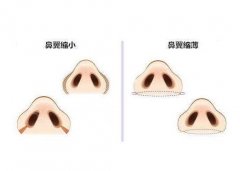 鼻翼縮小手術(shù)需要多久？什么時(shí)候可以拆線？