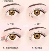 眼角增生能自動恢復嗎？開眼角的每個人都會增生嗎？
