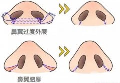鼻翼內(nèi)切會(huì)增生嗎，內(nèi)切有什么注意事項(xiàng)?