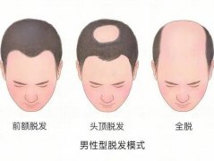 植發(fā)的時(shí)候要不要剃光頭？