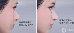 玻尿酸豐蘋果肌方法!自體脂肪填充方法豐蘋果肌!
