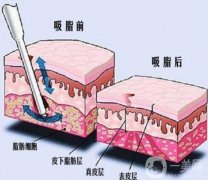 抽脂后皮膚會(huì)松弛嗎?為什么抽脂后皮膚會(huì)松弛?