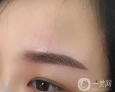 激光洗眉有疤痕怎么辦？多久可以恢復(fù)？