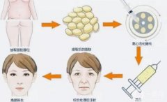自體脂肪豐臉嗎?自體脂肪豐蘋(píng)果肌多少錢(qián)?