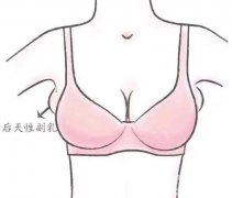 副乳切除術(shù)價格的影響因素有哪些？