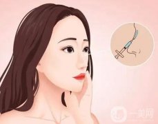 鼻孔縮小手術(shù)的恢復(fù)與消腫需要多長時(shí)間？