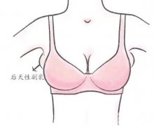 副乳切除后會復(fù)發(fā)嗎？副乳切除術(shù)有哪些風(fēng)險？