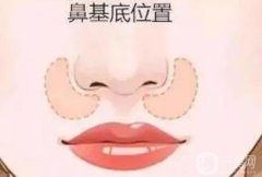 墊鼻基底后笑容僵硬嗎?影響面部表情嗎？