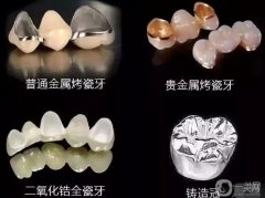 烤瓷牙怎么保養(yǎng)？