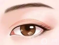 定點(diǎn)雙眼皮有什么優(yōu)點(diǎn)和缺點(diǎn)？