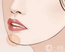 墊下巴之后多久可以吃飯，多久消腫？