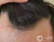 發(fā)際線整形有哪些危害？