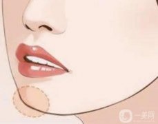 墊下巴手術(shù)后多長(zhǎng)時(shí)間可以消腫？