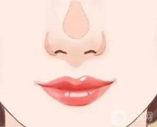 墊鼻梁多久能恢復(fù)？
