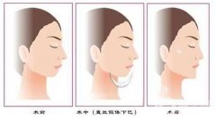 墊下巴能否改良臉型？墊下巴有哪些材料