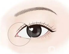不適合開(kāi)眼角的人群有哪些？