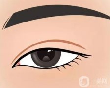 做微創(chuàng)雙眼皮后有哪些需要注意？
