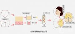 自體脂肪填充面部痛嗎？自體脂肪豐胸滲出怎么辦呢？