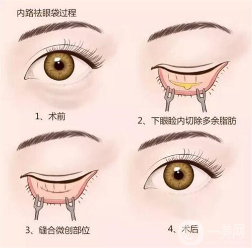 天津公安醫(yī)院整形價格表2020年，內(nèi)附做眼袋*圖