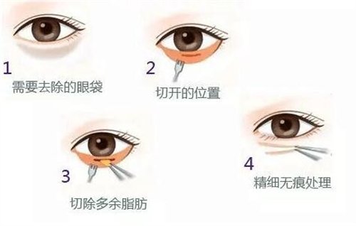 天津公安醫(yī)院整形價格表2020年，內(nèi)附做眼袋*圖
