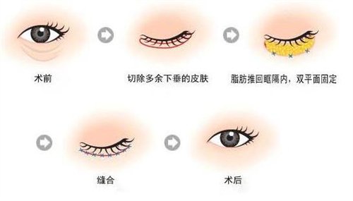 天津公安醫(yī)院整形價格表2020年，內(nèi)附做眼袋*圖