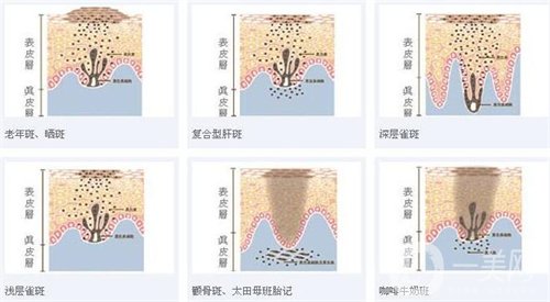 天津醫(yī)科大學(xué)腫瘤醫(yī)院整形科價(jià)格表，附激光祛斑恢復(fù)*果圖