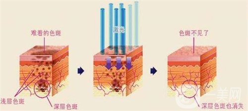 天津醫(yī)科大學(xué)腫瘤醫(yī)院整形科價(jià)格表，附激光祛斑恢復(fù)*果圖