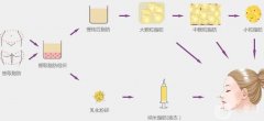 自體脂肪填充有后遺癥和風險嗎？