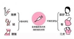 自體脂肪豐胸需要進行多少次手術(shù)？