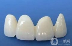 烤瓷牙脫落如何修復(fù)？做烤瓷牙有哪些必要性？