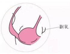 副乳切除后會(huì)復(fù)發(fā)嗎？副乳切除術(shù)有什么后遺癥？