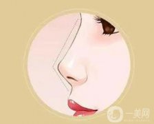 矯正朝天鼻的價(jià)格是多少？