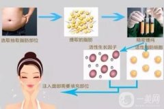 自體脂肪填充一次能填充多少？